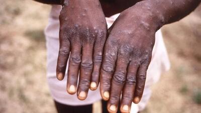 شیوع یک بیماری کشنده و مرگبار در آفریقا