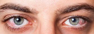 خشکی چشم بیماری خطرناکی است؟