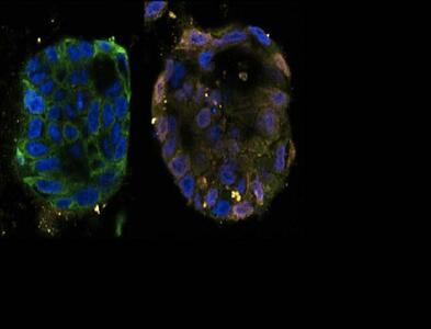 کشف مسیر جدید مرگ سلول‌های سرطانی