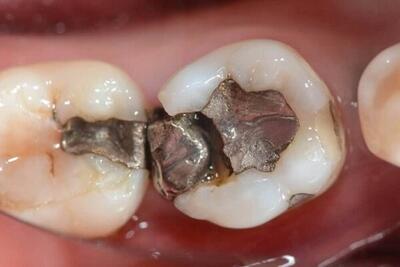 ۳ روش‌ پر کردن دندان شکسته که باید بدانید