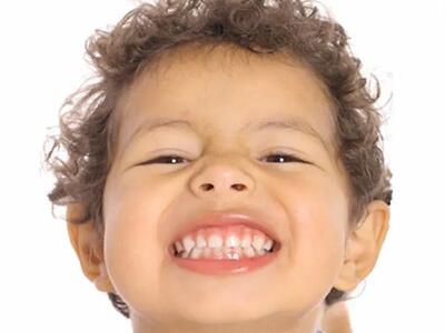 دلیل بیرون زدن دندان اضافه کودک (دلایل ایجاد دندان اضافه و درمان آن)