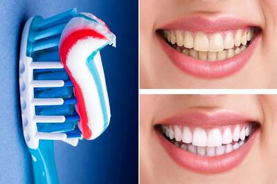 سفید کردن فوری دندان در خانه/ برا وقتی که واسه یه قرار مهم عجله داری مثه مروارید میشن