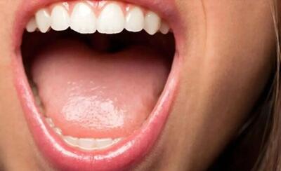 هرآنچه باید از کبودی زبان بدانید! / علت کبودی زبان چیست ؟