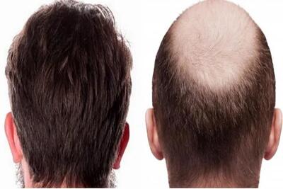 فوری فوری؛ افرادی مشکل «ریزش مو» دارند حتما بخوانند| درمان ریزش مو با نتایج موفق و دائمی - اندیشه قرن