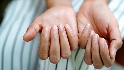 تشخیص سرطان از روی ناخن‌
