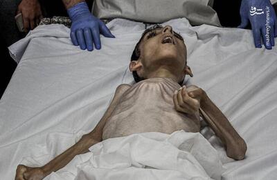 فیلم/ شهادت یک کودک دیگر فلسطینی بر اثر سوء تغذیه