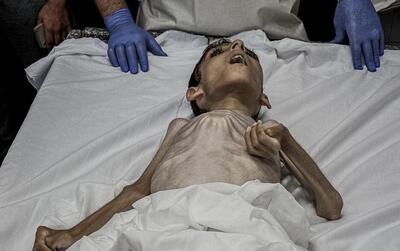 تصویر بسیار تکان‌دهنده از شهادت کودک فلسطینی بر اثر سوء تغذیه