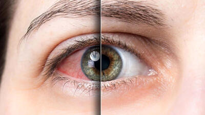 16 راهکار پیشگیری از خشکی چشم