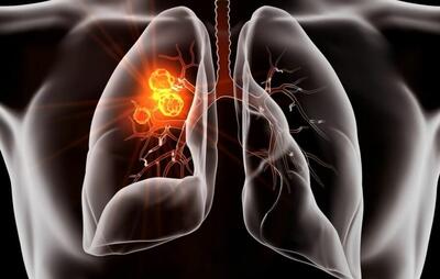 موفقیت قرص جدید سرطان ریه در آزمایش‌های بالینی