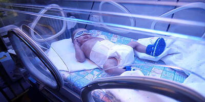 اجاره دستگاه زردی نوزاد / سریع ترین راه درمان زردی نوزاد!