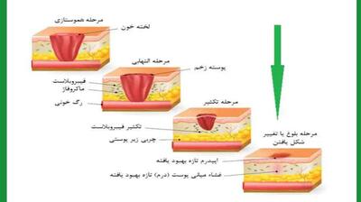 میگنا - مراحل بهبود زخم  با توجه به نوع زخم، متفاوت است.