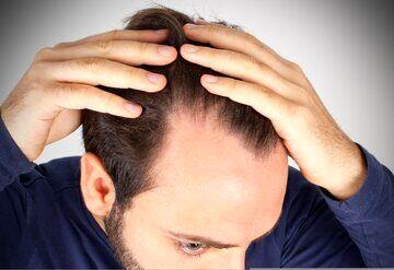 ۴ عامل مهم ریزش مو را بشناسید