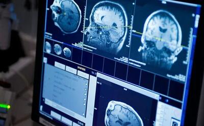 امید تازه دانشمندان برای درمان سرطان کشنده مغز