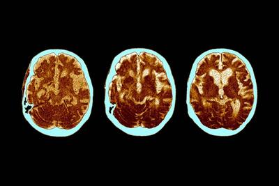 چرا مغز برخی افراد در برابر آلزایمر مقاوم است؟