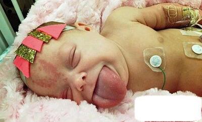 نوزاد زبان بزرگ بالاخره توانست بخندد +عکس