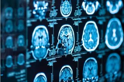 امید تازه دانشمندان مغز برای درمان سرطان از بین برنده مغز