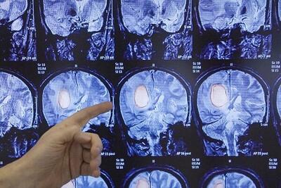 علائم تومور مغزی چیست؟