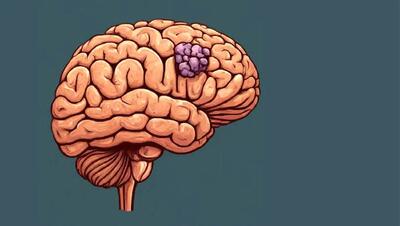 عواملی که ریسک ابتلا به تومور مغزی را بالا می برد
