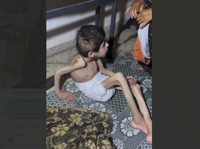 تصاویر تلخ از سوء تغذیه کودک فلسطینی |+ ویدئو