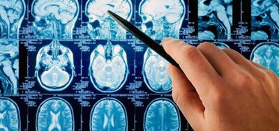 نابودی سلول‌های تومور مغزی با پرتو ایکس