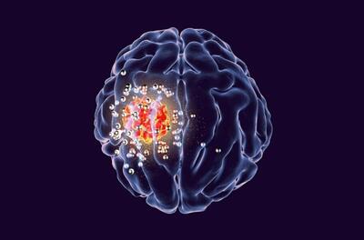 اشعه ایکس با دوز کم می‌تواند سلول‌های تومور مغزی را از بین ببرد!