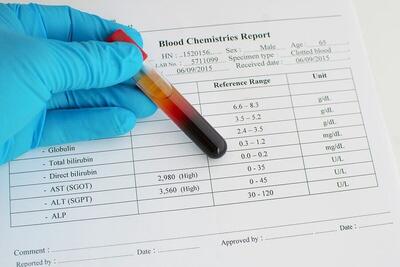 آزمایش خون SGOT: همه چیز درباره این تست، تفسیر نتایج و آمادگی