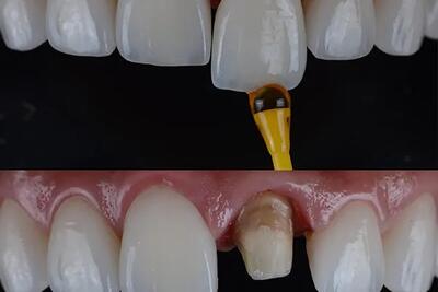 آیا کامپوزیت ونیر باعث پوسیدگی دندان میشود؟ همه چیز راجع‌به کامپوزیت مشهد - اندیشه قرن