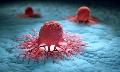 3 سرطان شایع در مردان ایرانی/5 عامل موثر در بروز سرطان پروستات