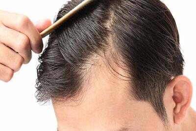 ریزش مو چه موقع غیرطبیعی است؟