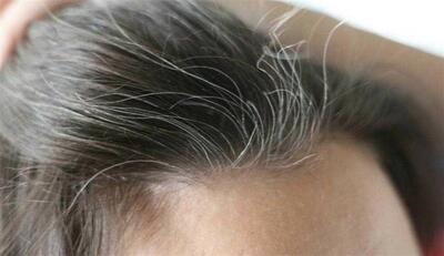 ۵ علت مهم سفید شدن مو