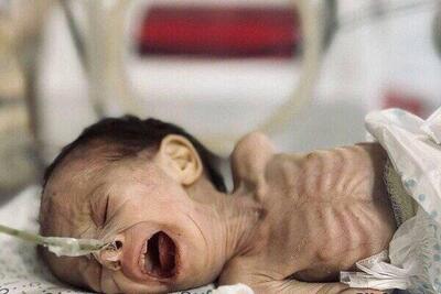 شهادت یک کودک بر اثر گرسنگی در غزه