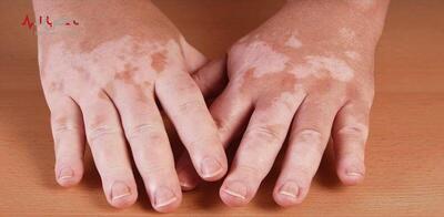 لکه‌های سفید روی پوستتان نشانه کدام بیماری است؟