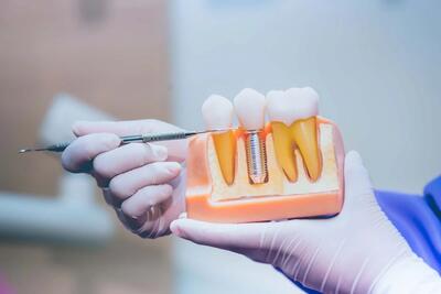 نکات مهم در مراقبت قبل و بعد از ایمپلنت دندان چیست؟