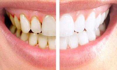 آیا جرم گیری دندان کار درستی است؟