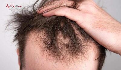 معجزه ویتامین‌ها برای رشد مو و جلوگیری از ریزش مو