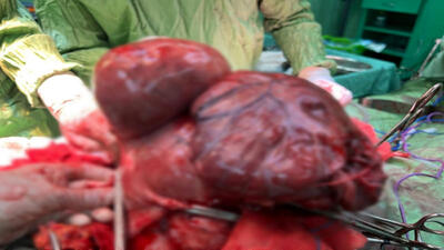 عکس تومور ۱۱ کیلویی که از شکم  زن بیمار خارج شد / شوکه می شوید