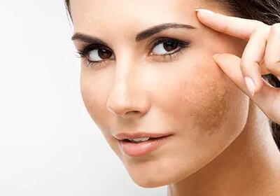 چگونه آرایش کنیم که لکه‌های پوستی مشخص نشود؟ / راهکارهای مؤثر برای پوشاندن لکه‌های پوستی