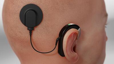 ابداع میکروفون قابل کاشت در بدن برای ناشنوایان