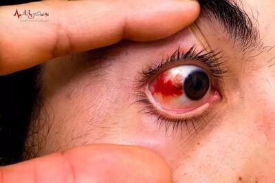 راز نهفته در قرمزی چشم‌ها چیست؟ این علامت می‌تواند خبر از این بیماری‌های پنهان و خطرناک بدهد