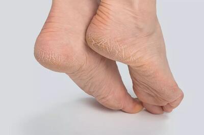 کشف ارتباط خشکی پوست کف پا با نارسایی کبد