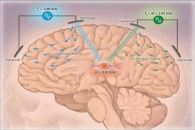 راه جدیدی برای درمان افسردگی توسط تحریک مغناطیسی عمیق مغز