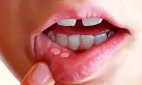 بهترین درمان‌های خانگی برای آفت دهان: روش‌های موثر و طبیعی برای تسکین درد و بهبود زخم‌ها