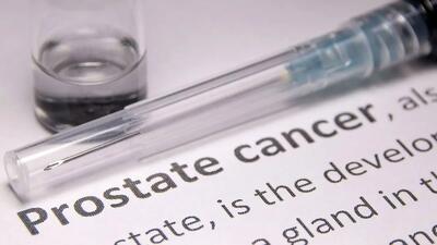 سرطان پروستات: تشخیص زودهنگام و گزینه‌های درمانی موثر