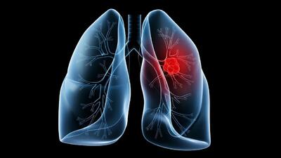 سرطان ریه: علائم اولیه و درمان‌های نوین