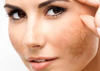 چگونه لک‌های روی پوست را سریع و مؤثر پاک کنیم: راهکارها و روش‌های درمان خانگی