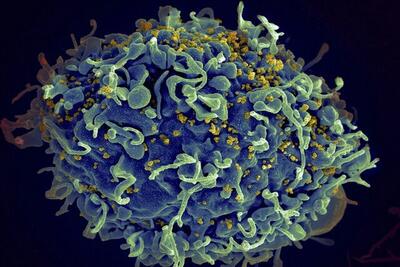 درمان کامل هفتمین مبتلا به ایدز در جهان