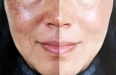 علت تیرگی پوست صورت+ راه های درمان