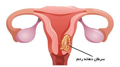 علائم هشدار دهنده سرطان دهانه رحم که باید بدانید