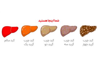 درمان قطعی کبد چرب گرید۲ + رژیم غذایی پاکسازی در خانه