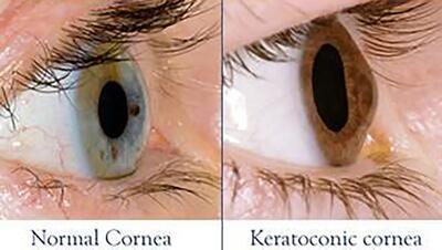 جدیدترین روش‌ درمان قوز قرنیه + در قوز قرنیه چه اتفاقی برای چشم می افتد؟